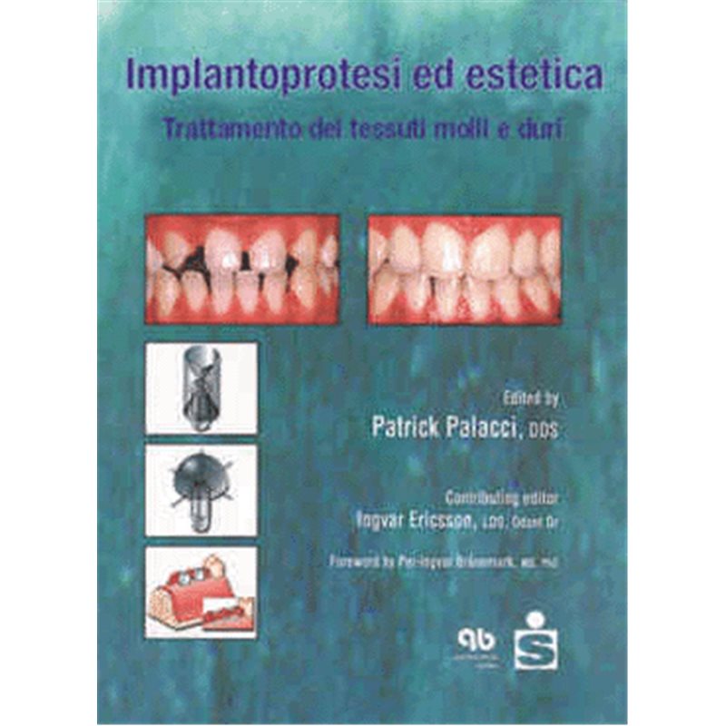 Implantoprotesi ed estetica
